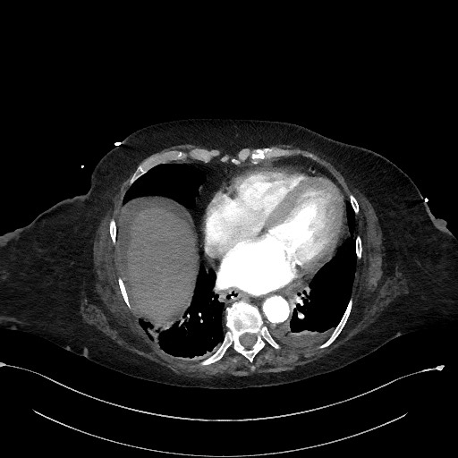 Active renal extravasation with large subcapsular and retroperitoneal hemorrhage (Radiopaedia 60975-68796 Axial C+ arterial phase 15).jpg