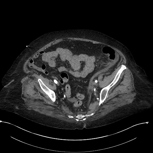 Active renal extravasation with large subcapsular and retroperitoneal hemorrhage (Radiopaedia 60975-68796 Axial C+ arterial phase 158).jpg