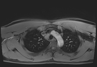 File:Active right ventricular cardiac sarcoidosis (Radiopaedia 55596-62100 Axial Post contrast Dixon 10).jpg