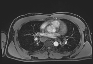 File:Active right ventricular cardiac sarcoidosis (Radiopaedia 55596-62100 Axial Post contrast Dixon 35).jpg