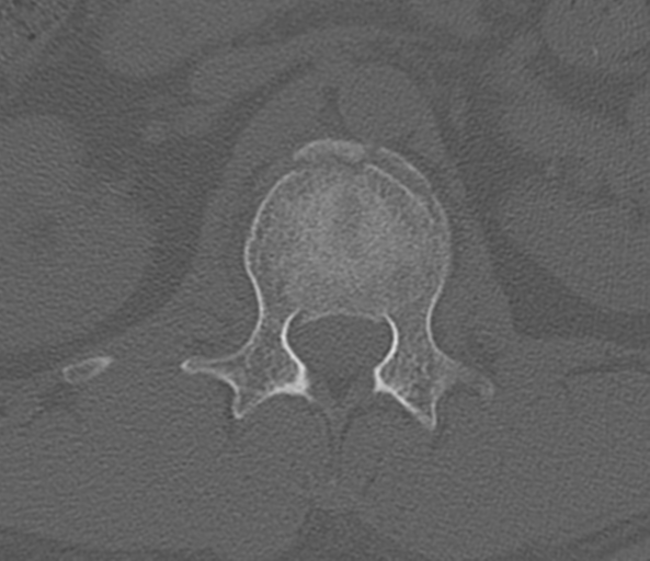 File:Acute L1 burst compression fracture (Radiopaedia 34430-35755 Axial bone window 21).png
