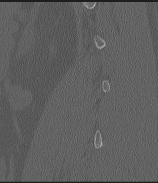 Acute L1 burst compression fracture (Radiopaedia 34430-35755 Sagittal bone window 14).png
