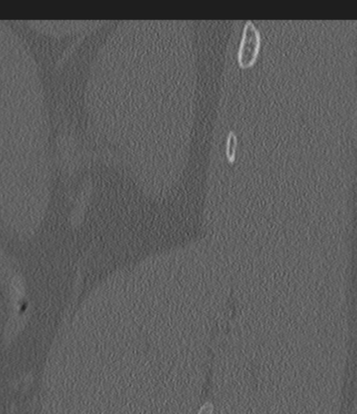 Acute L1 burst compression fracture (Radiopaedia 34430-35755 Sagittal bone window 61).png