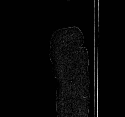 Acute appendicitis, heterotaxy syndrome (Radiopaedia 66884-76202 Sagittal C+ portal venous phase 6).jpg