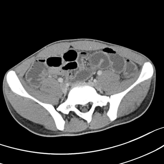 File:Acute appendicitis (Radiopaedia 32614-33572 Axial C+ portal venous phase 47).jpg