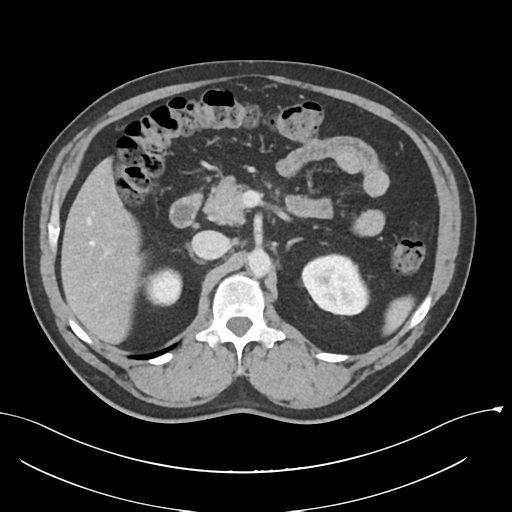 Acute appendicitis (Radiopaedia 36611-38177 Axial C+ portal venous phase 34).png