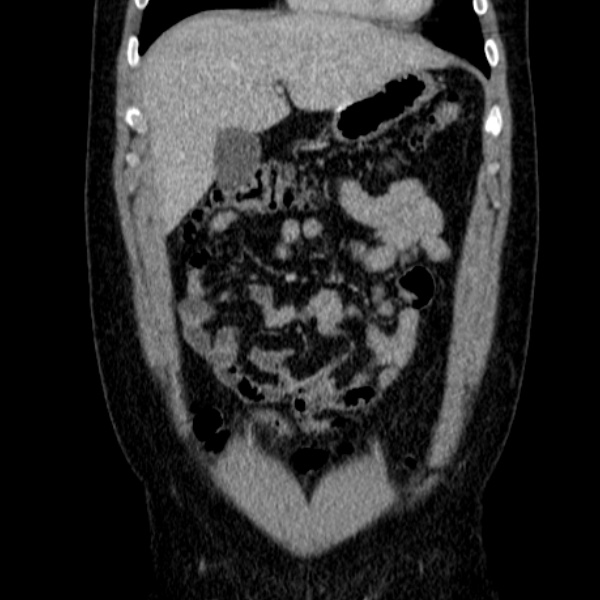 Acute appendicitis (Radiopaedia 38255-40270 Coronal C+ portal venous phase 25).jpg