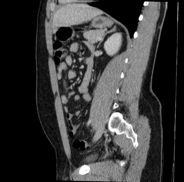 Acute appendicitis (Radiopaedia 38255-40270 Sagittal C+ portal venous phase 52).jpg