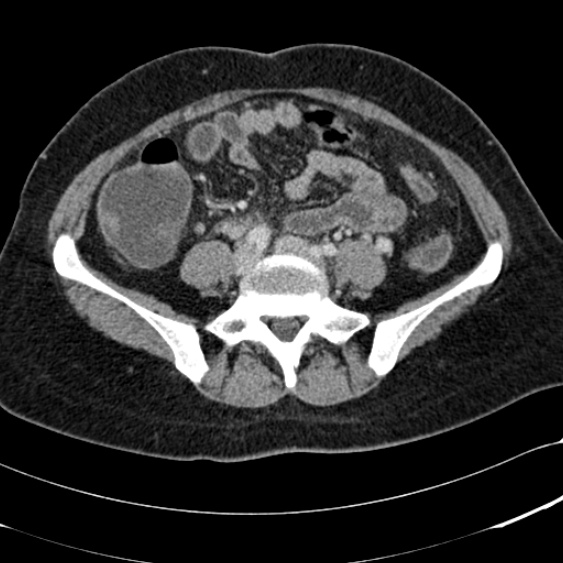 File:Acute appendicitis (Radiopaedia 48792-53822 Axial C+ portal venous phase 76).jpg
