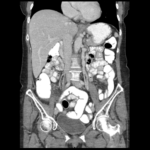 Acute appendicitis (Radiopaedia 52672-58589 Coronal C+ portal venous phase 50).jpg