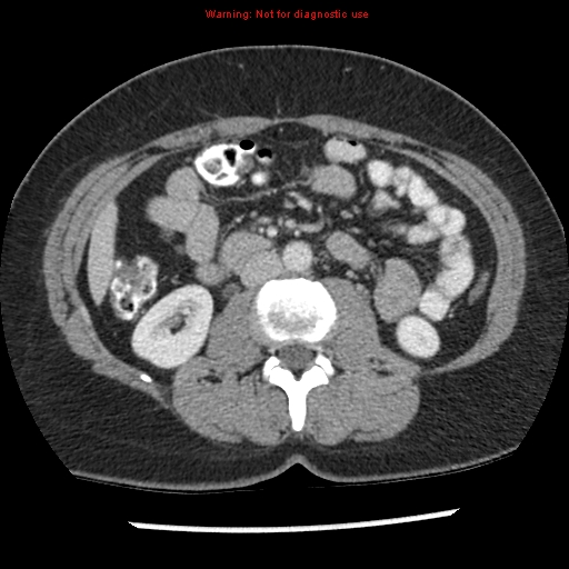 File:Acute appendicitis (Radiopaedia 7966-8812 C+ portal venous phase 20).jpg