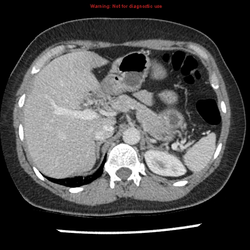 File:Acute appendicitis (Radiopaedia 7966-8812 C+ portal venous phase 6).jpg