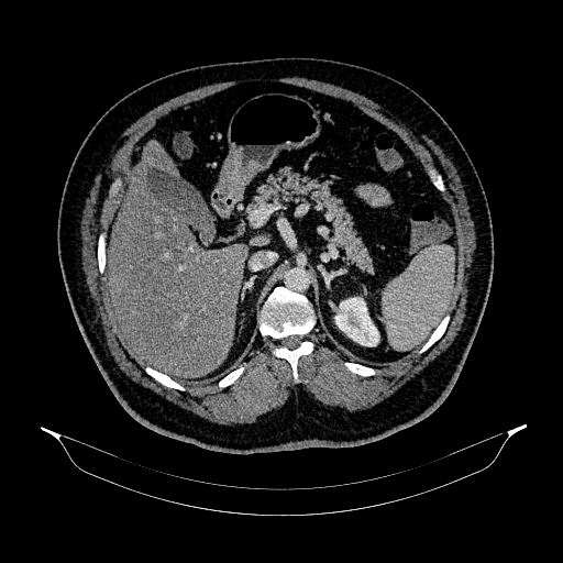 Acute appendicitis (Radiopaedia 79950-93224 Axial C+ portal venous phase 33).jpg