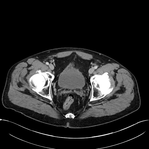 Acute appendicitis - large appendicoliths (Radiopaedia 61805-69820 Axial C+ portal venous phase 120).jpg