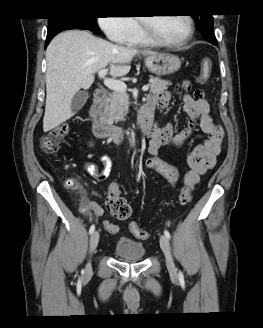 Acute appendicitis - large appendicoliths (Radiopaedia 61805-69820 Coronal C+ portal venous phase 58).jpg