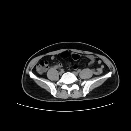 Acute appendicitis and COVID 19 pneumonia (Radiopaedia 76604-88380 Axial non-contrast 94).jpg