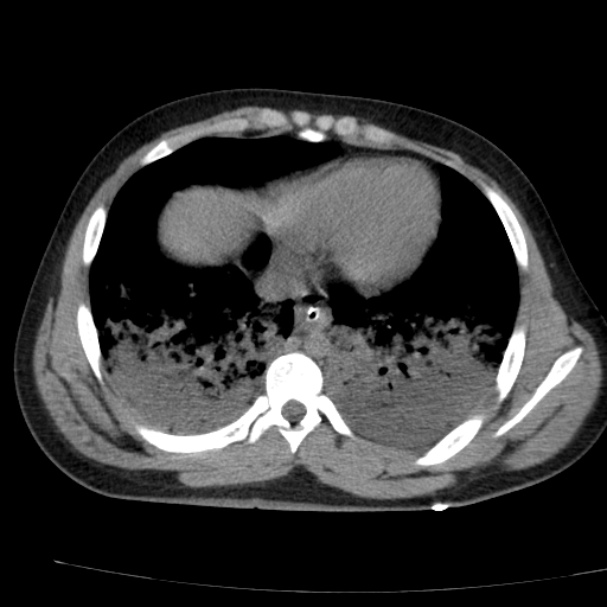 Acute aspiration pneumonitis (Radiopaedia 33605-34703 Axial non-contrast 61).jpg