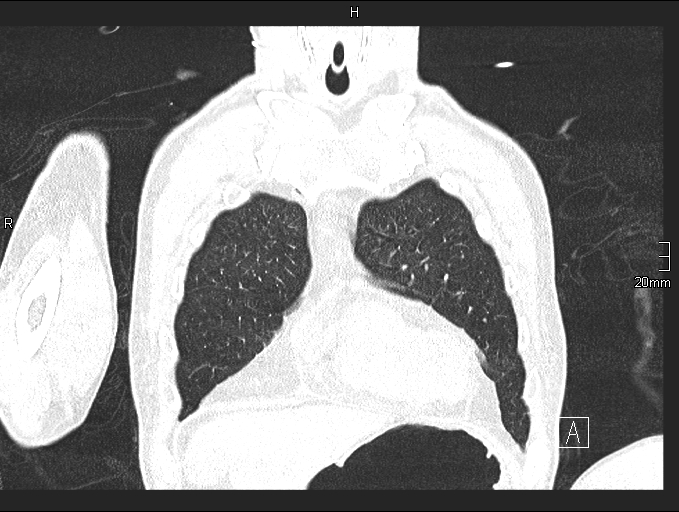 Acute aspiration pneumonitis (Radiopaedia 55642-62166 Coronal lung window 18).jpg