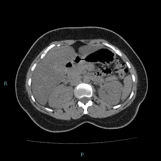 Acute bilateral pyelonephritis (Radiopaedia 37146-38881 Axial non-contrast 37).jpg