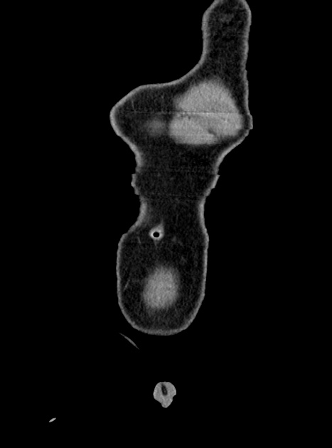 Acute bowel ischemia (Radiopaedia 87695-104114 Coronal C+ portal venous phase 58).jpg