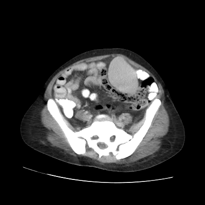 Acute calculous cholecystitis in patient with osteopetrosis (Radiopaedia 77871-90159 Axial C+ portal venous phase 60).jpg