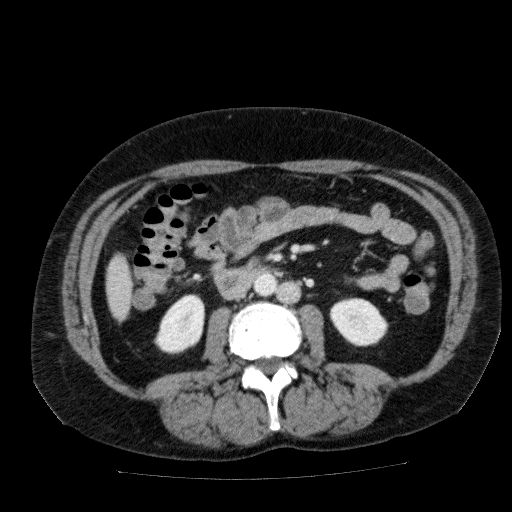 File:Acute cholecystitis and incidental left sided IVC (Radiopaedia 49352-54459 Axial C+ portal venous phase 79).jpg