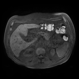 Acute cholecystitis complicated by pylephlebitis (Radiopaedia 65782-74915 Axial T1 fat sat 50).jpg