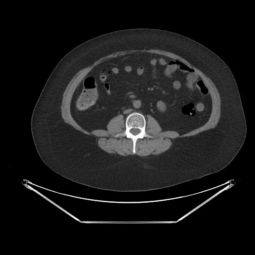 Acute cholecystitis with tensile fundus sign (Radiopaedia 71394-81723 Axial non-contrast 54).jpg