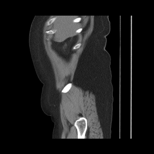 Acute cholecystitis with tensile fundus sign (Radiopaedia 71394-81723 Sagittal non-contrast 38).jpg
