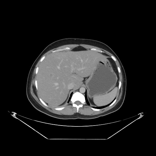 File:Acute complicated calculous cholecystitis (Radiopaedia 55202-61587 Axial C+ delayed 26).jpg