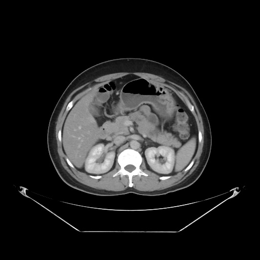File:Acute complicated calculous cholecystitis (Radiopaedia 55202-61587 Axial C+ delayed 38).jpg