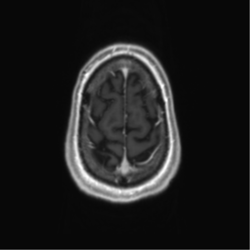 Acute disseminated encephalomyelitis (ADEM) (Radiopaedia 65319-74350 Axial T1 C+ 60).png