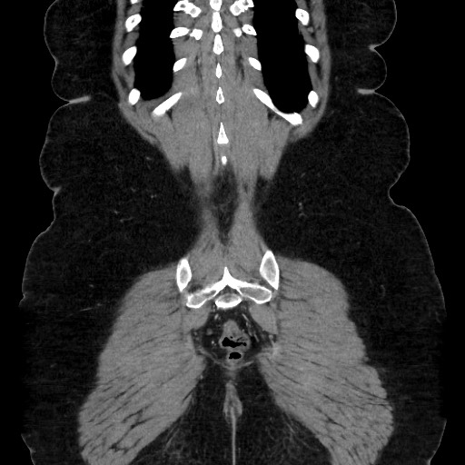 Acute diverticulitis - transverse colon (Radiopaedia 87063-103327 Coronal C+ portal venous phase 134).jpg