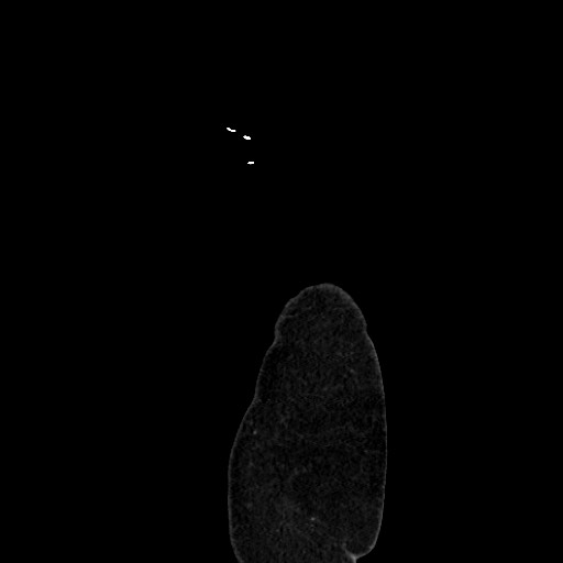 Acute diverticulitis - transverse colon (Radiopaedia 87063-103327 Sagittal C+ portal venous phase 235).jpg