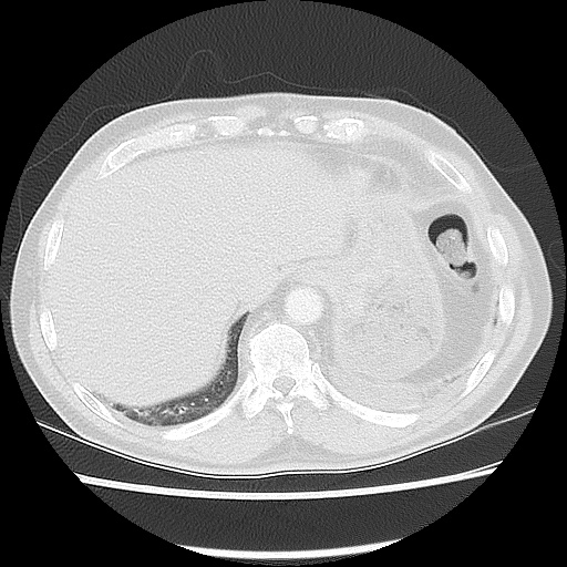 Acute epicardial fat necrosis (Radiopaedia 42327-45440 Axial lung window 48).jpg