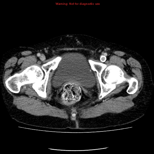 File:Acute gangrenous cholecystitis (Radiopaedia 10123-10661 Axial C+ portal venous phase 99).jpg