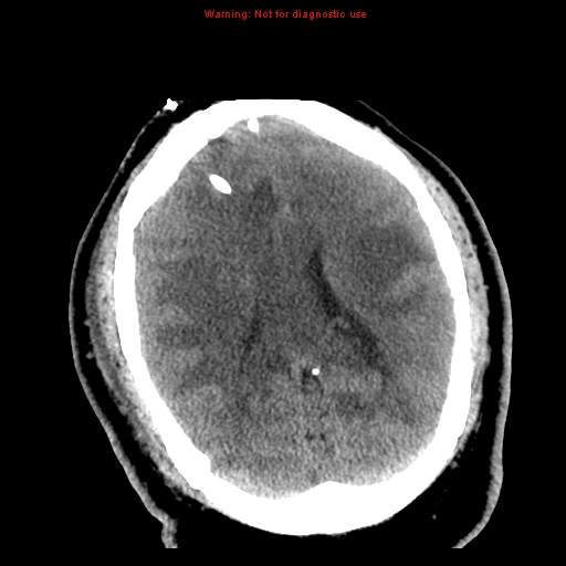 File:Acute hemorrhagic leukoencephalitis (Radiopaedia 14076-72275 Axial non-contrast 25).jpg