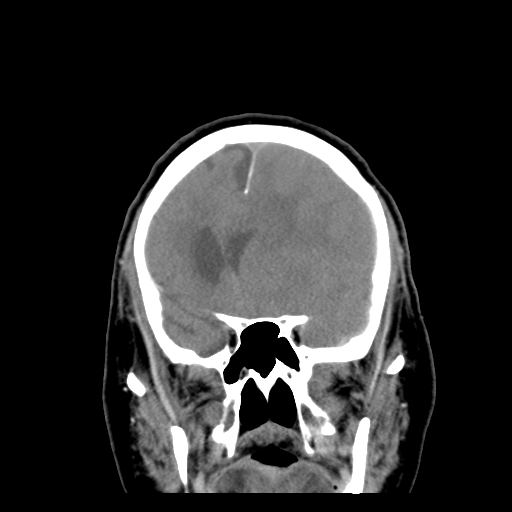 Acute hemorrhagic stroke (Radiopaedia 17507-17223 Coronal non-contrast 17).jpg