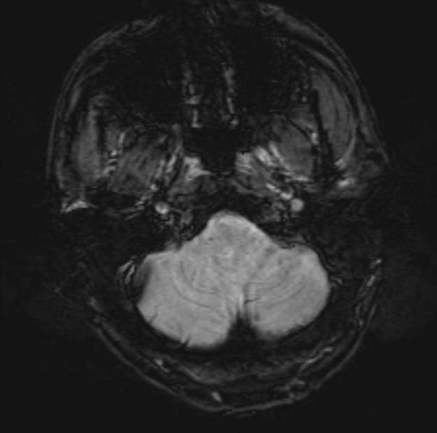 Acute ischemic stroke - posterior circulation territory (Radiopaedia 77670-89880 Axial SWI 8).jpg