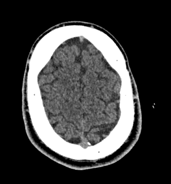 Acute ischemic stroke - posterior circulation territory (Radiopaedia 77670-89881 non-contrast 78).jpg