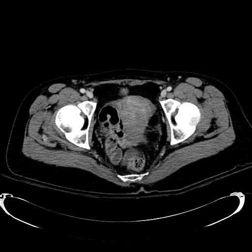 Acute myocardial infarction in CT (Radiopaedia 39947-42415 Axial C+ portal venous phase 125).jpg