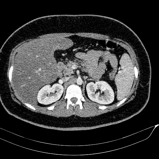 Acute on chronic pancreatitis (Radiopaedia 80902-94423 Axial C+ portal venous phase 58).jpg