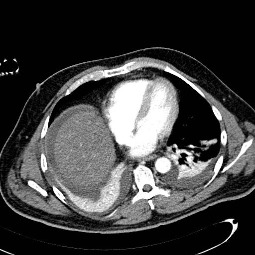 File:Acute pancreatic necrosis (Radiopaedia 13560-13486 Axial C+ portal venous phase 11).jpg
