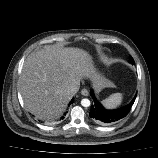Acute pancreatitis (Radiopaedia 26663-26813 Axial C+ arterial phase 17).jpg