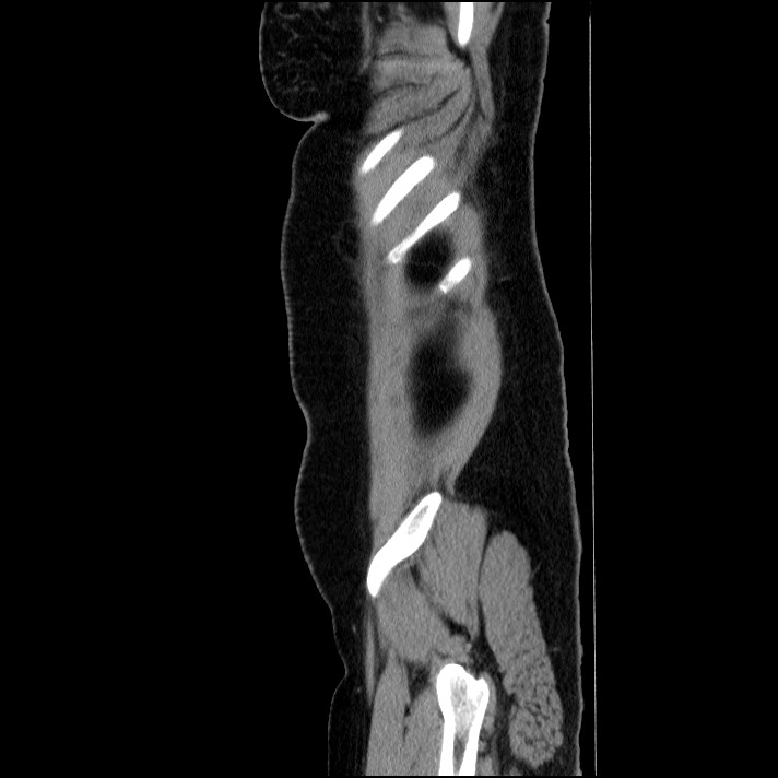 Acute pancreatitis (Radiopaedia 69236-79012 Sagittal C+ portal venous phase 19).jpg