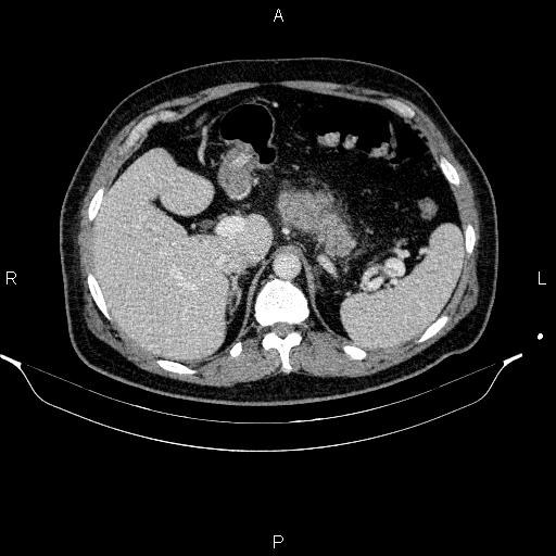 Acute pancreatitis (Radiopaedia 85390-101010 Axial C+ portal venous phase 27).jpg