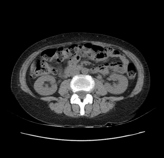 File:Acute pancreatitis - Balthazar E - post ERCP (Radiopaedia 27562-27772 Axial non-contrast 32).png