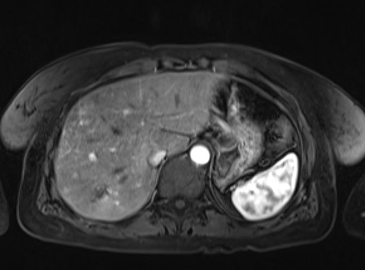 Acute pancreatitis - Balthazar E - post ERCP (Radiopaedia 27562-27778 Axial VIBE C+ 26).png