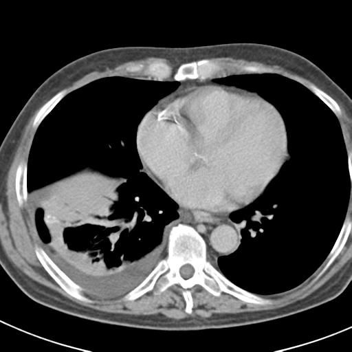 File:Acute pancreatitis and walled-off necrosis (Radiopaedia 29888-30403 Axial C+ delayed 5).jpg