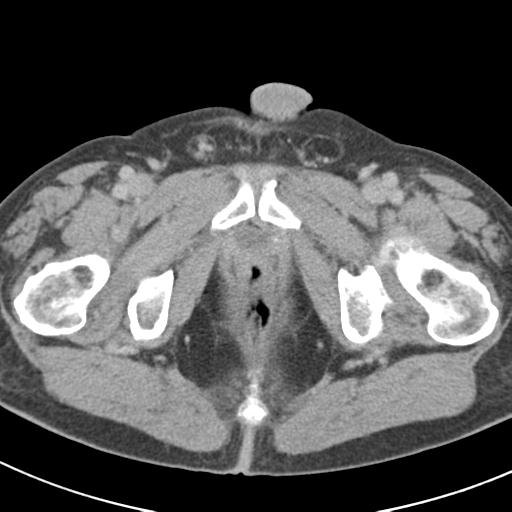 Acute pancreatitis and walled-off necrosis (Radiopaedia 29888-30403 Axial C+ delayed 84).jpg